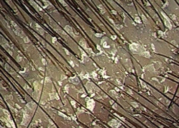Caspa: Tratamento e como eliminar