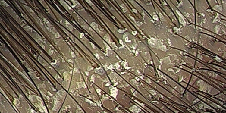 Caspa: Tratamento e como eliminar
