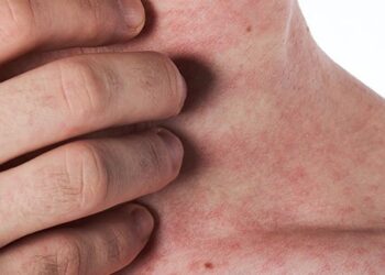 Quais são os sintomas do HIV?