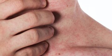 Quais são os sintomas do HIV?