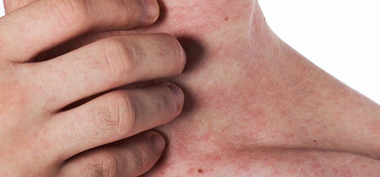 Quais são os sintomas do HIV?